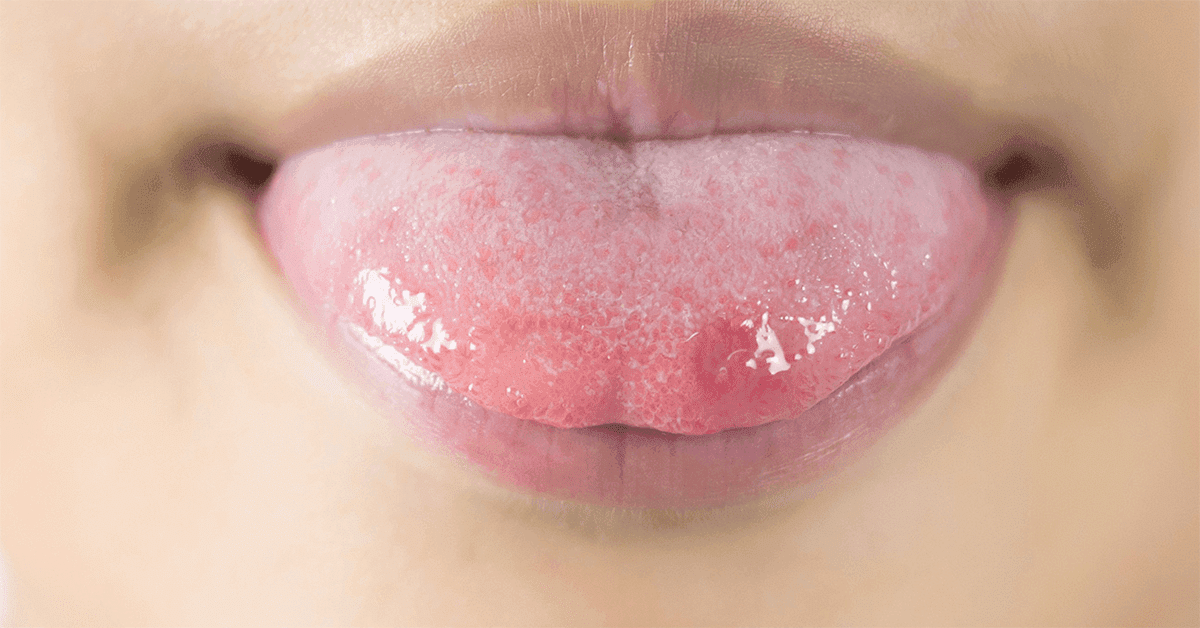 Jak vyléčit afty v puse a na jazyku